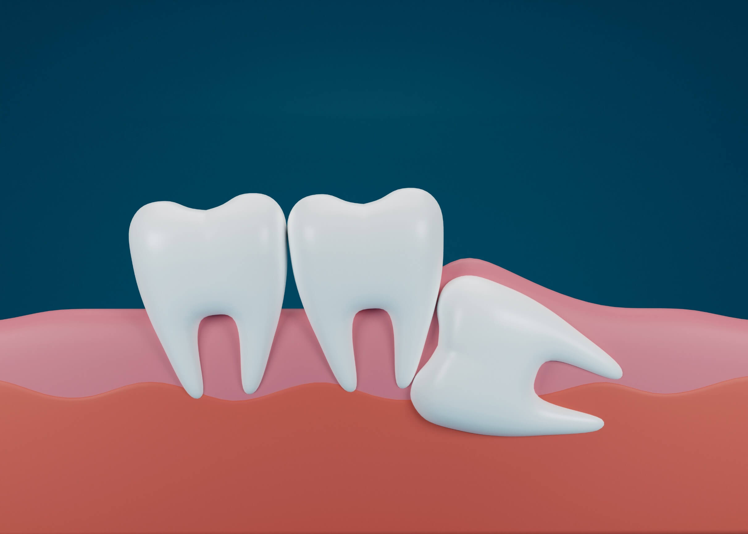 Wisdom Tooth Removal Navigating The Path To Relief Oral Surgeon