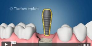 Video of Dental Implant Surgery with testimonial from a patient.