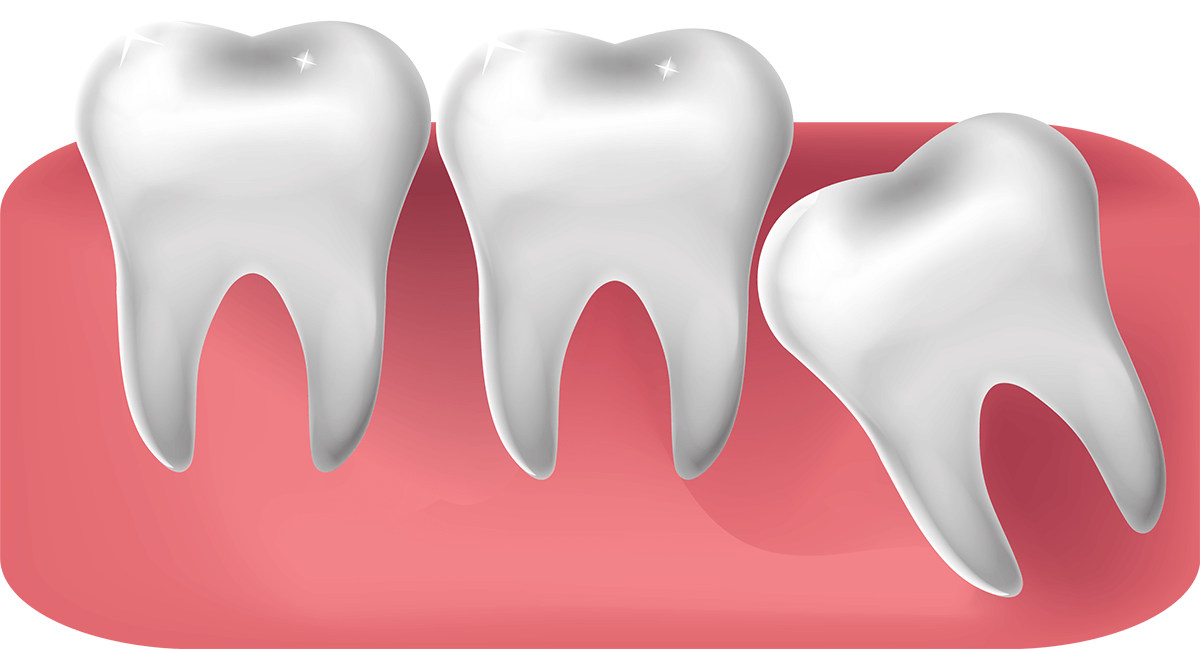 Illustration of impacted wisdom tooth.