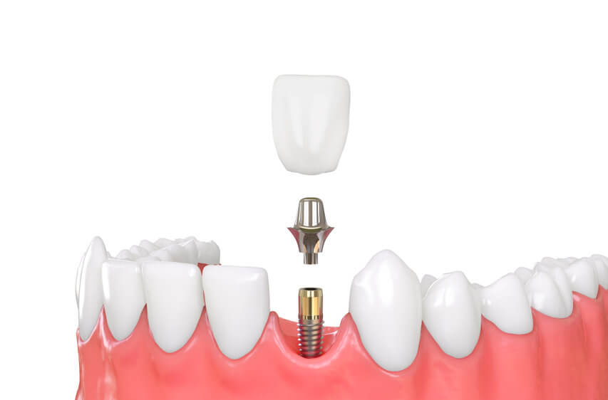 Denture implants illustration with crown and implant.