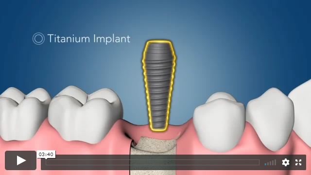 Dental Implant Surgery