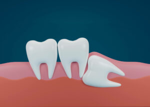 Illustration of impacted wisdom tooth.